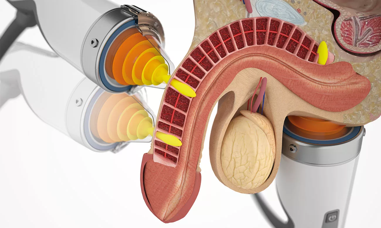 shockwave therapy for ed