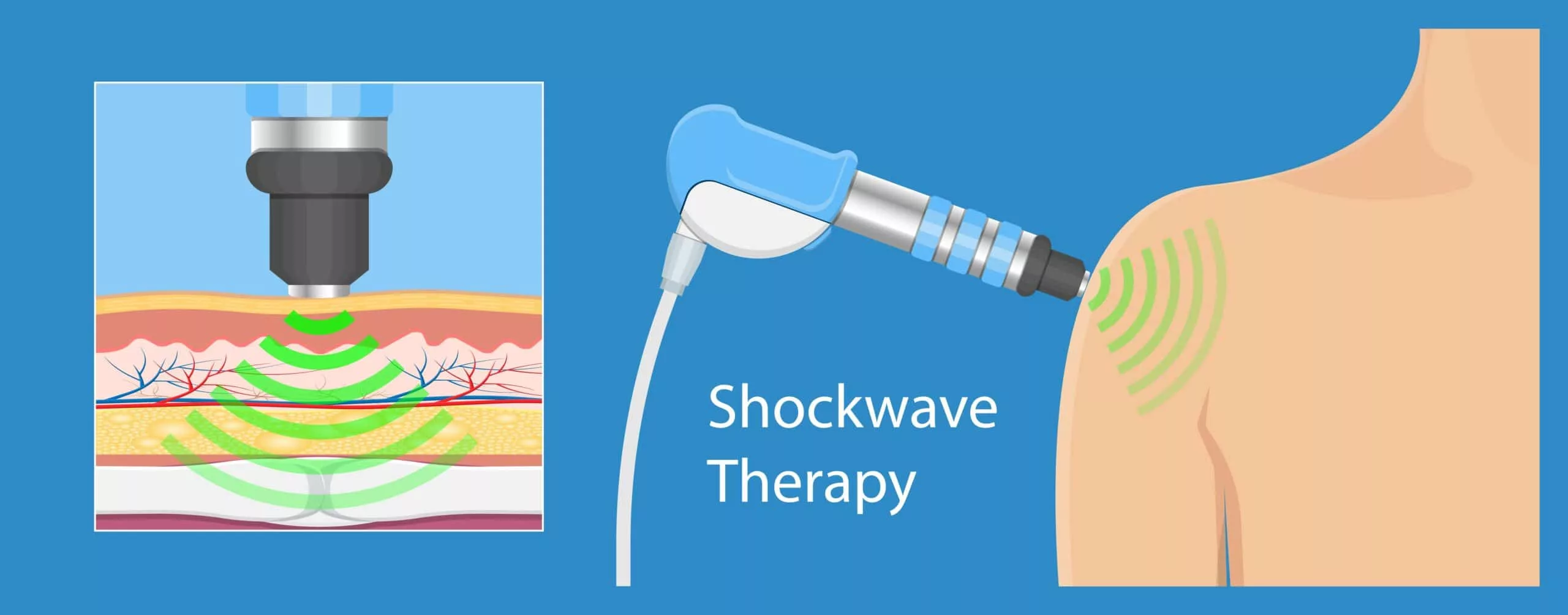 shockwave therapy