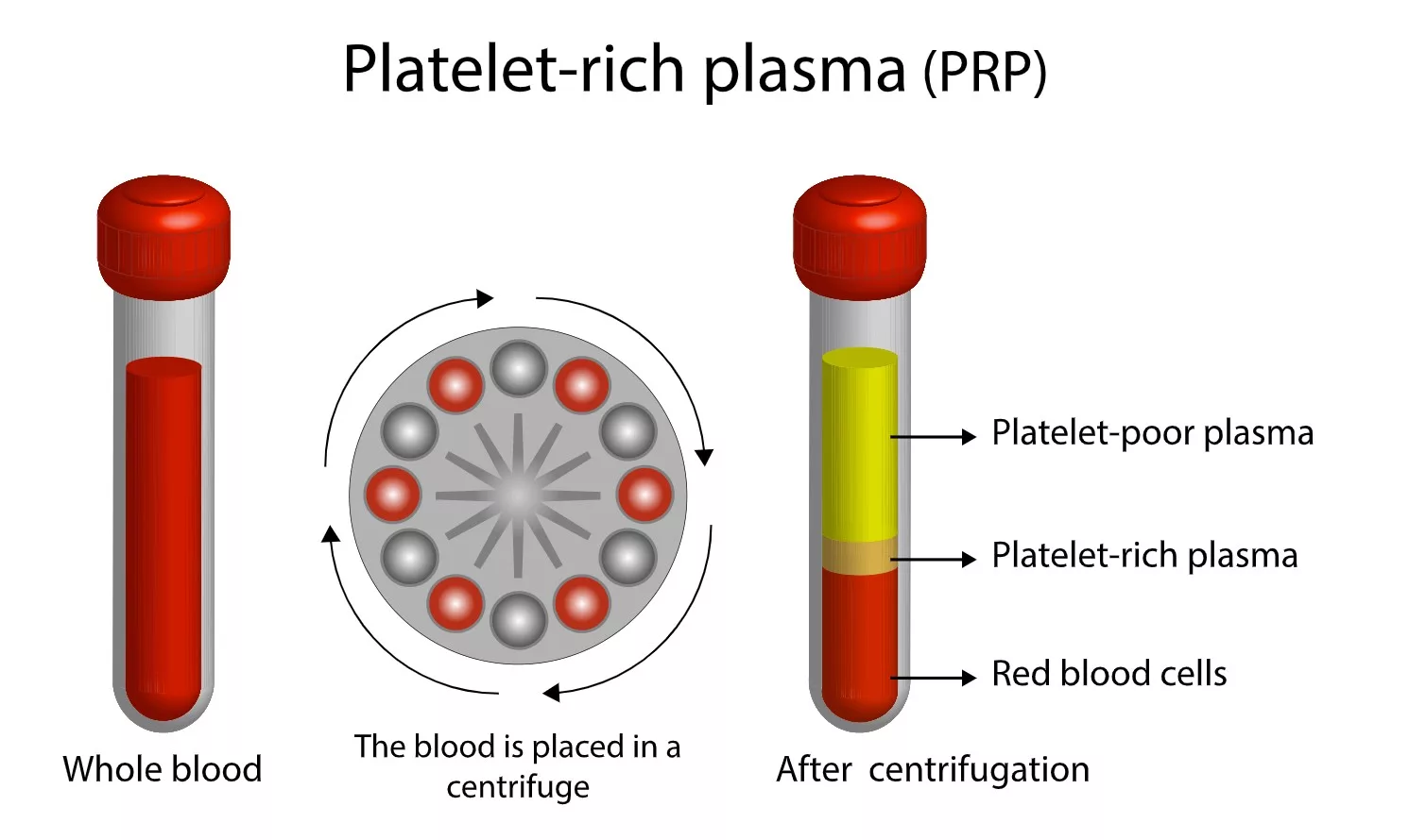 Platelet-Rich Plasma (PRP) Therapy 