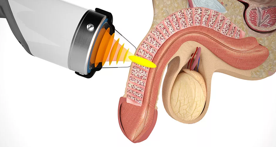 shockwave therapy